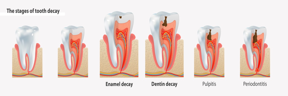 Лечение кариеса в Стокгольме | Renaissance Dental